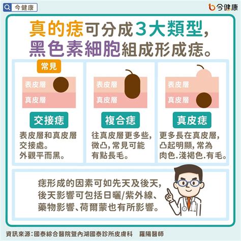 微凸的痣|是痣or皮膚癌？醫「1張圖秒對照」 長這2部位最危險